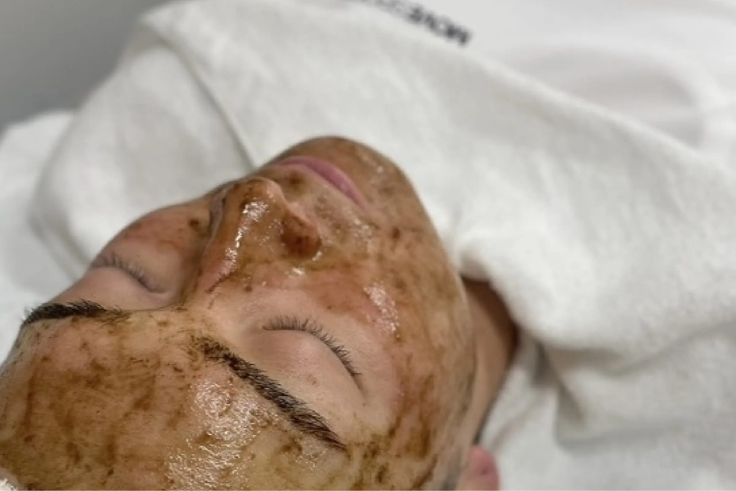 ハーブピーリング9980円（税込）/初回価格